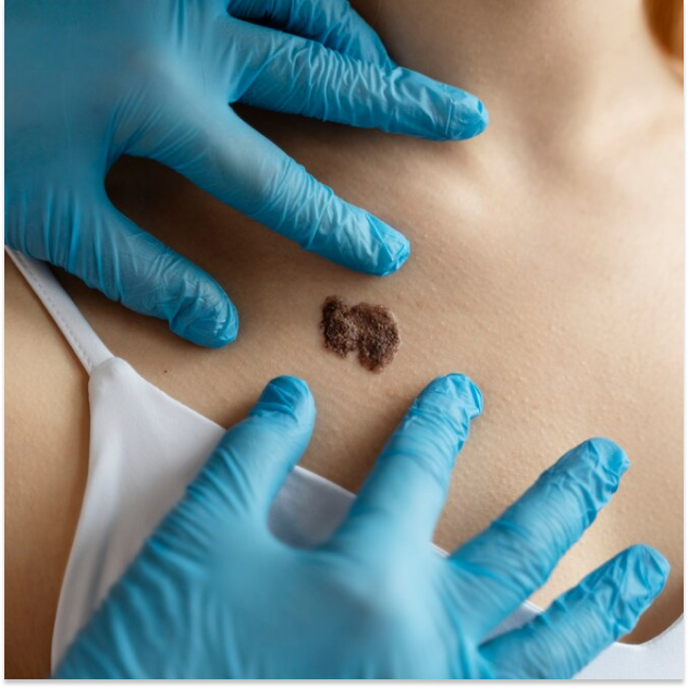 Wart & Tag Removal Treatment